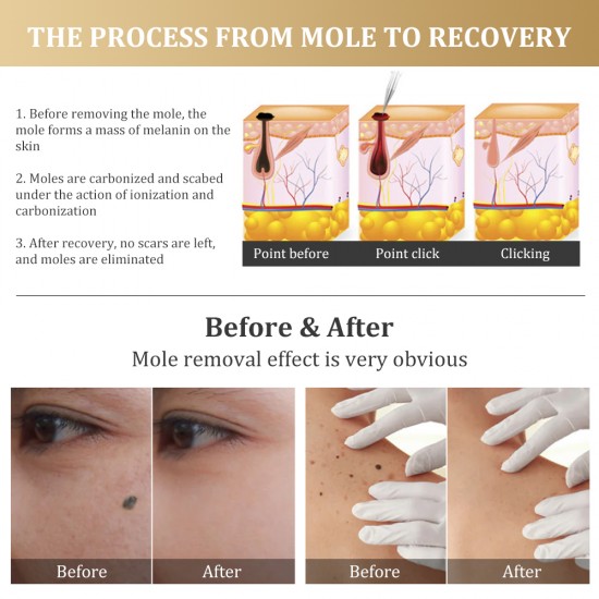 Mole Remover Pen,Skin Tag Remover Dark Spot Remover Freckle Tattoo Wart Mole Removal Tool,15 Levels Adjustable/LCD Screen